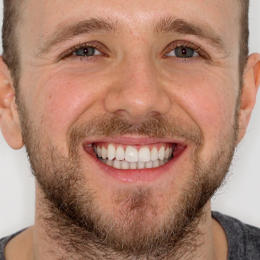 Invisalign vs Invisible Braces - after - 3Dental